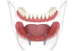 Prótesis removible sobre implantes 