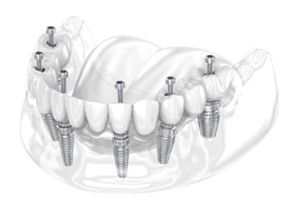 Rehabilitación Oral Completa Sobre Implantes